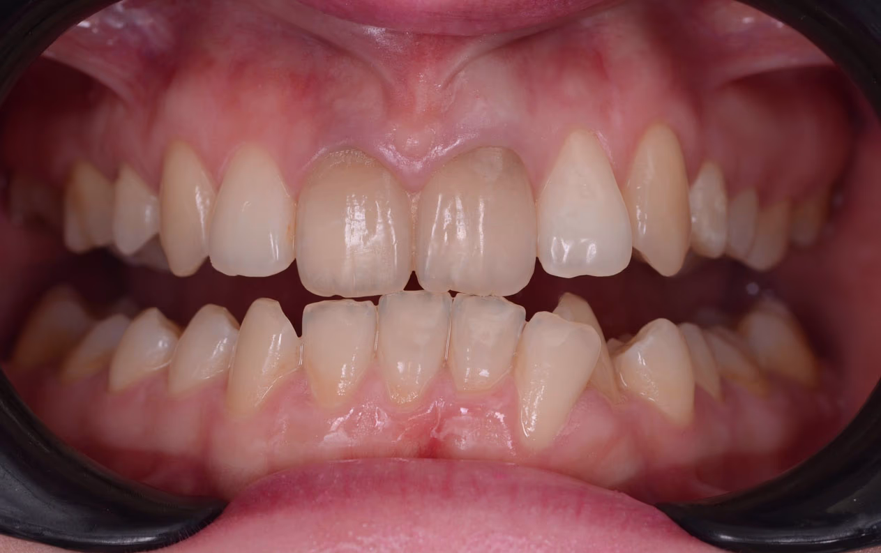 Результат ортодонтичного лікування — до (випадок 2)
